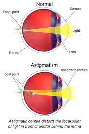 astigmatismos1
